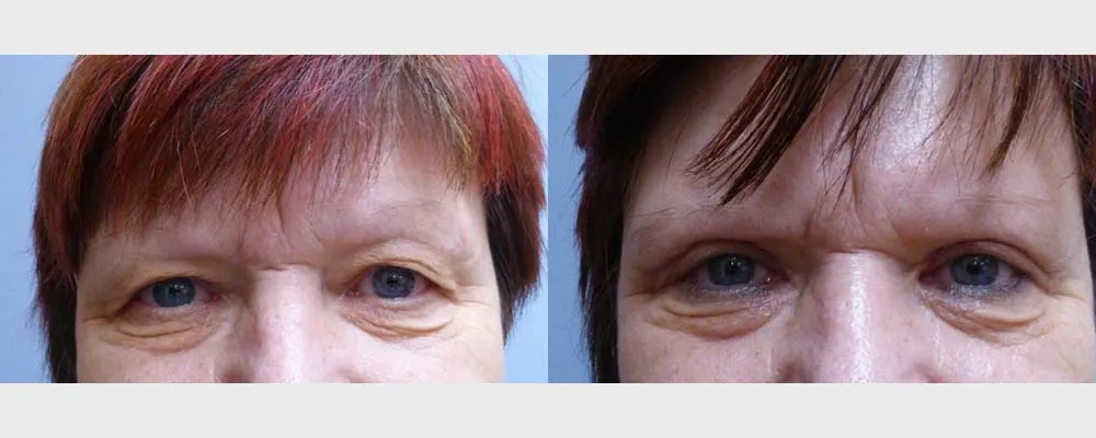 Корекція повік – Блефаропластика – результат 11