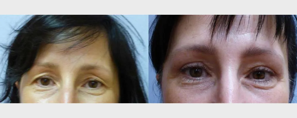 Корекція повік – Блефаропластика – результат 12