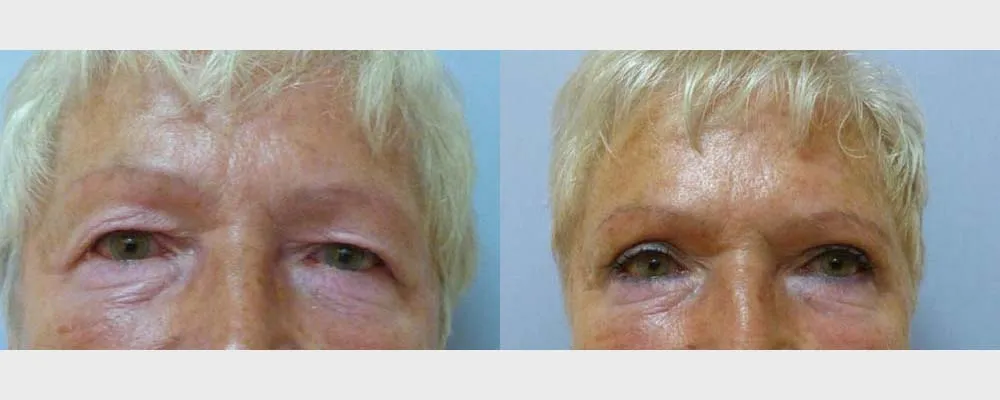 Корекція повік (Блефаропластика) – результат 4