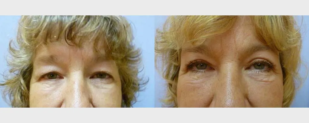 Корекція повік – Блефаропластика – результат 14