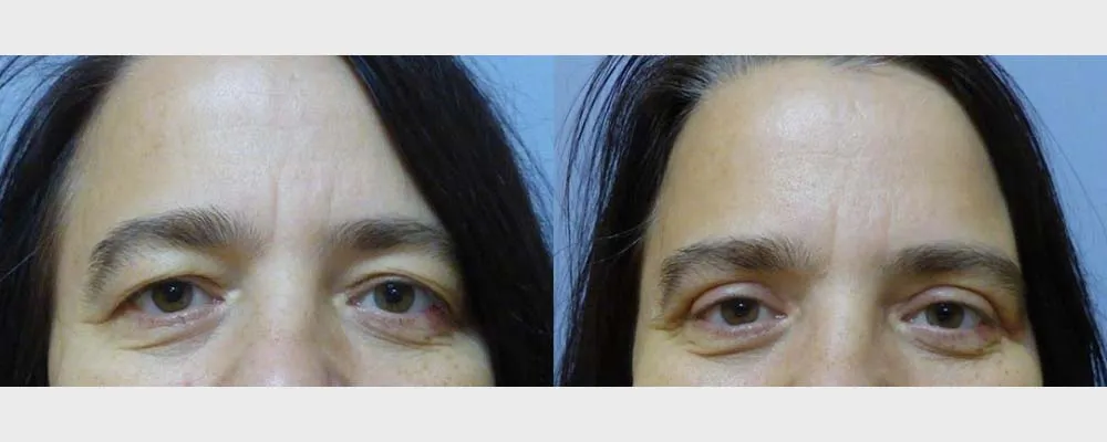 Корекція повік – Блефаропластика – результат 15