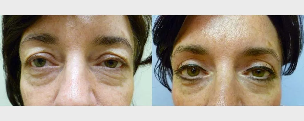 Корекція повік – Блефаропластика – результат 16