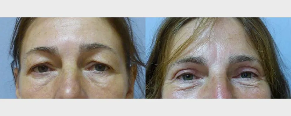 Корекція повік – Блефаропластика – результат 17