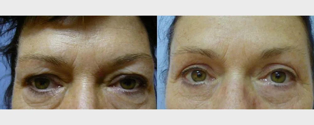 Корекція повік (Блефаропластика) – результат 5
