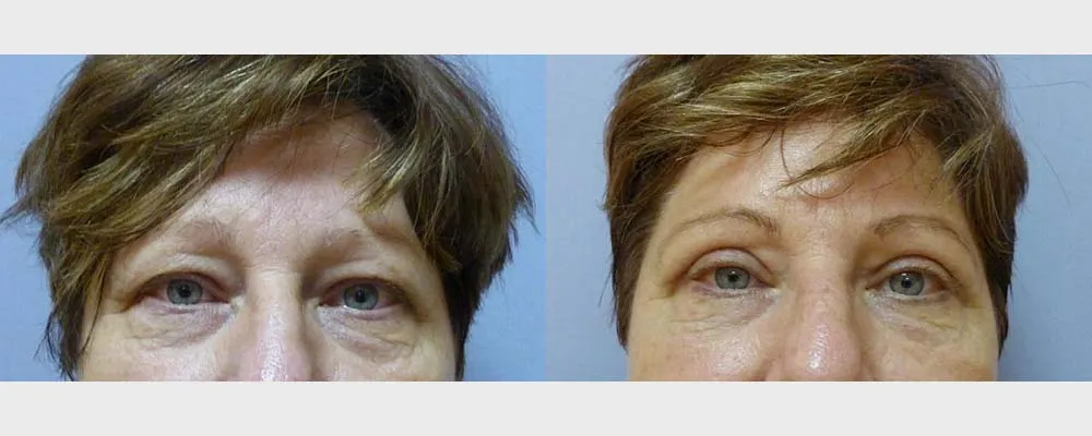 Корекція повік – Блефаропластика – результат 19