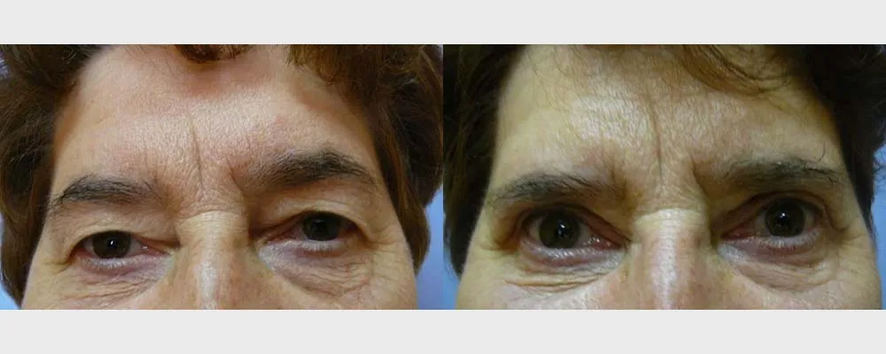 Корекція повік – Блефаропластика – результат 20