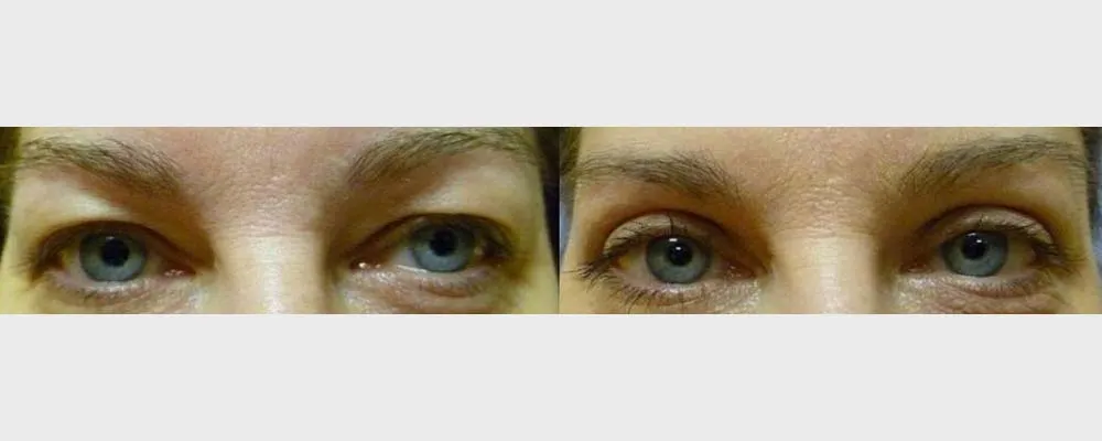 Корекція повік – Блефаропластика – результат 21