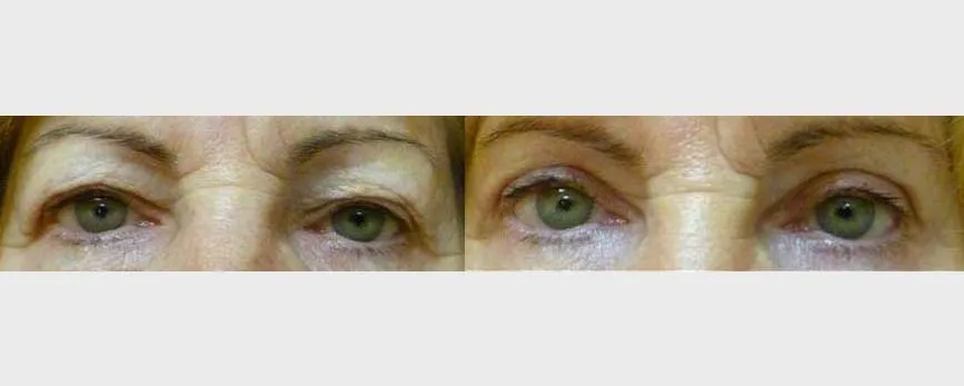 Корекція повік – Блефаропластика – результат 22