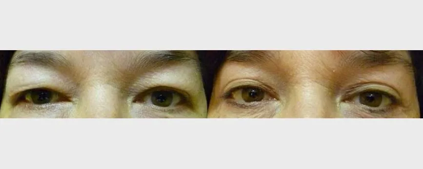 Корекція повік (Блефаропластика) – результат 6