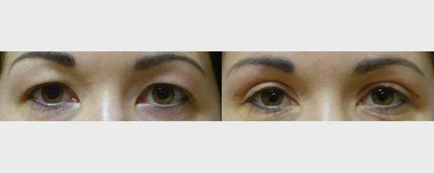 Корекція повік – Блефаропластика – результат 24
