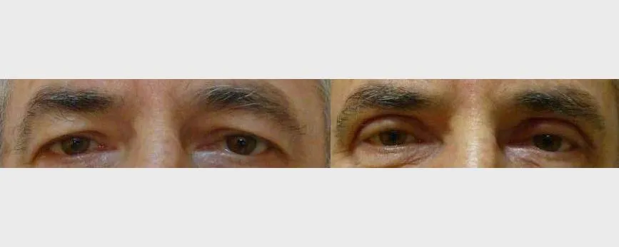 Корекція повік – Блефаропластика – результат 25