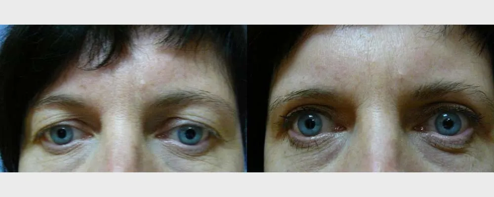 Корекція повік – Блефаропластика – результат 26