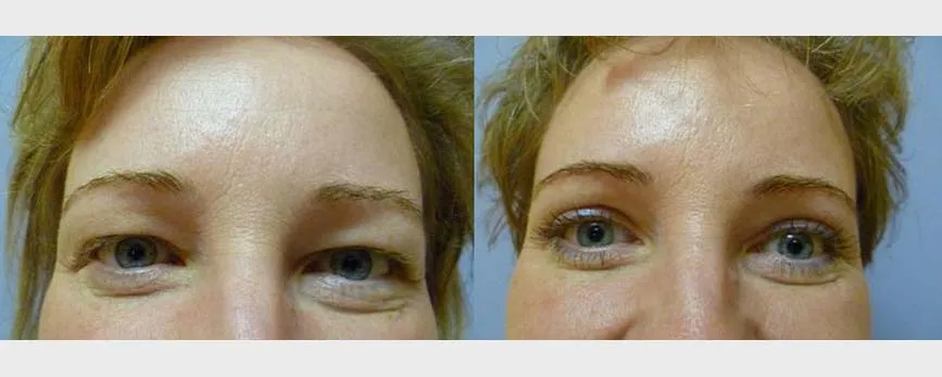 Корекція повік – Блефаропластика – результат 27