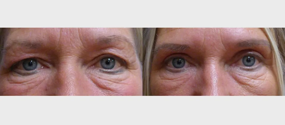 Корекція повік – Блефаропластика – результат 28