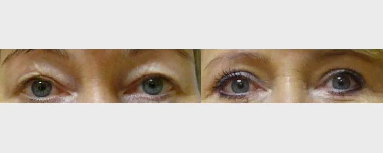 Корекція повік – Блефаропластика – результат 29