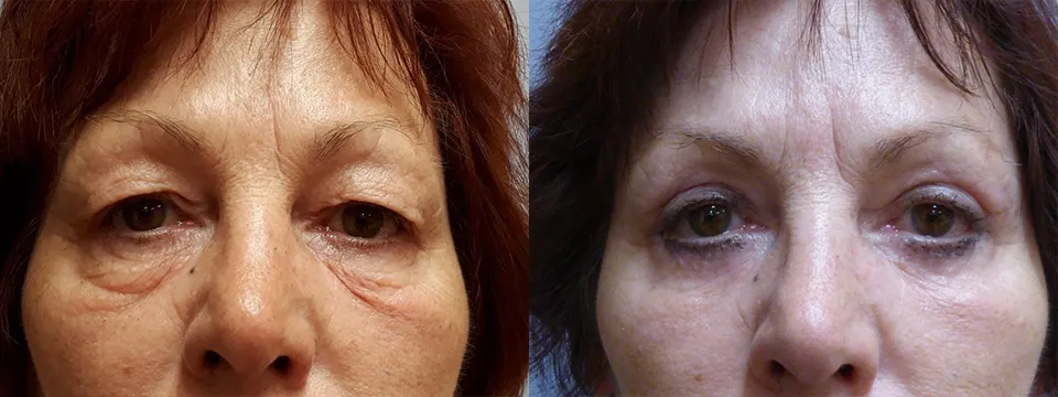 Корекція повік – Блефаропластика – результат 30