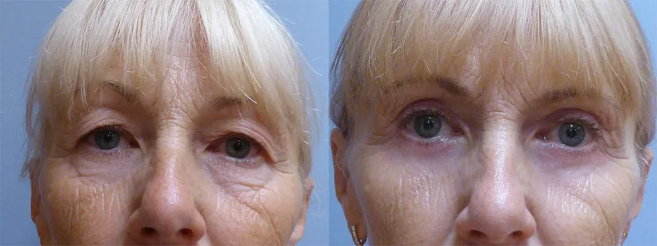 Корекція повік – Блефаропластика – результат 31