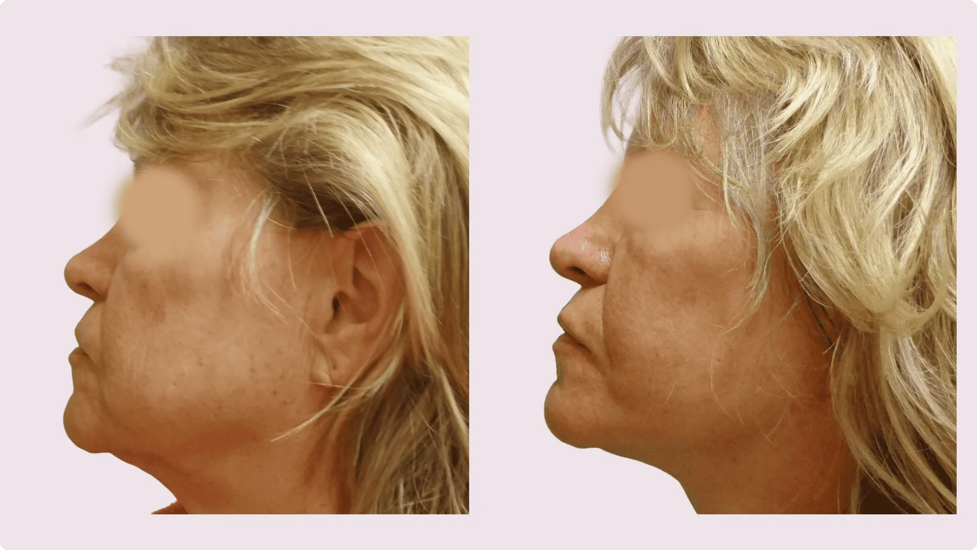 Facelifting – Rhytidektomie – Vorher-Nachher-Foto 4