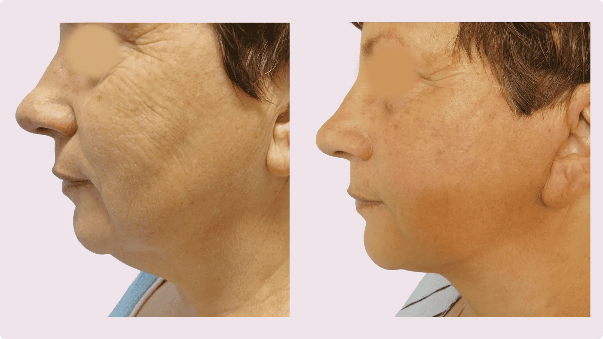 Facelifting – Rhytidektomie – Vorher-Nachher-Foto 5