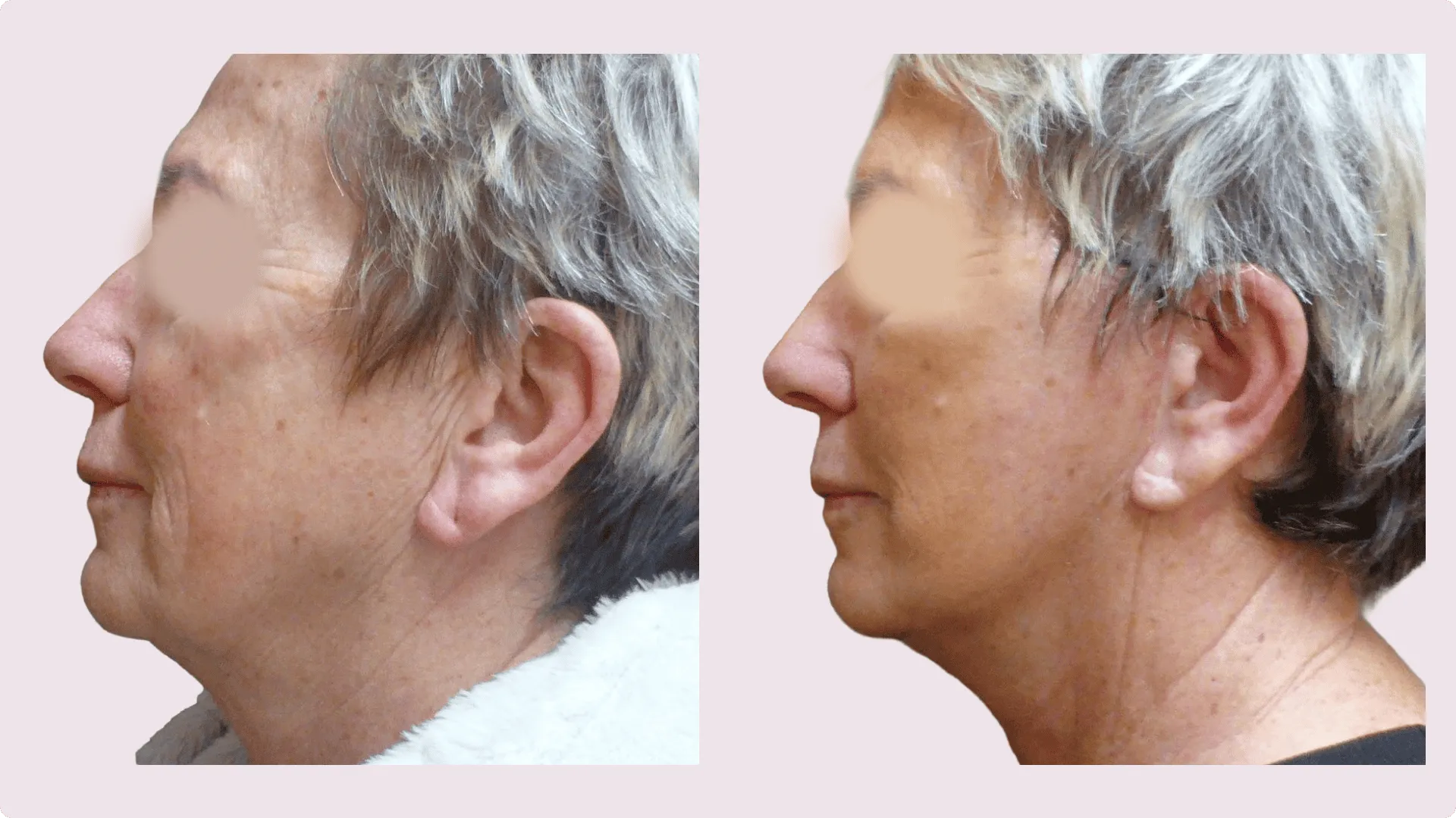 Facelifting – Rhytidektomie – Vorher-Nachher-Foto 6