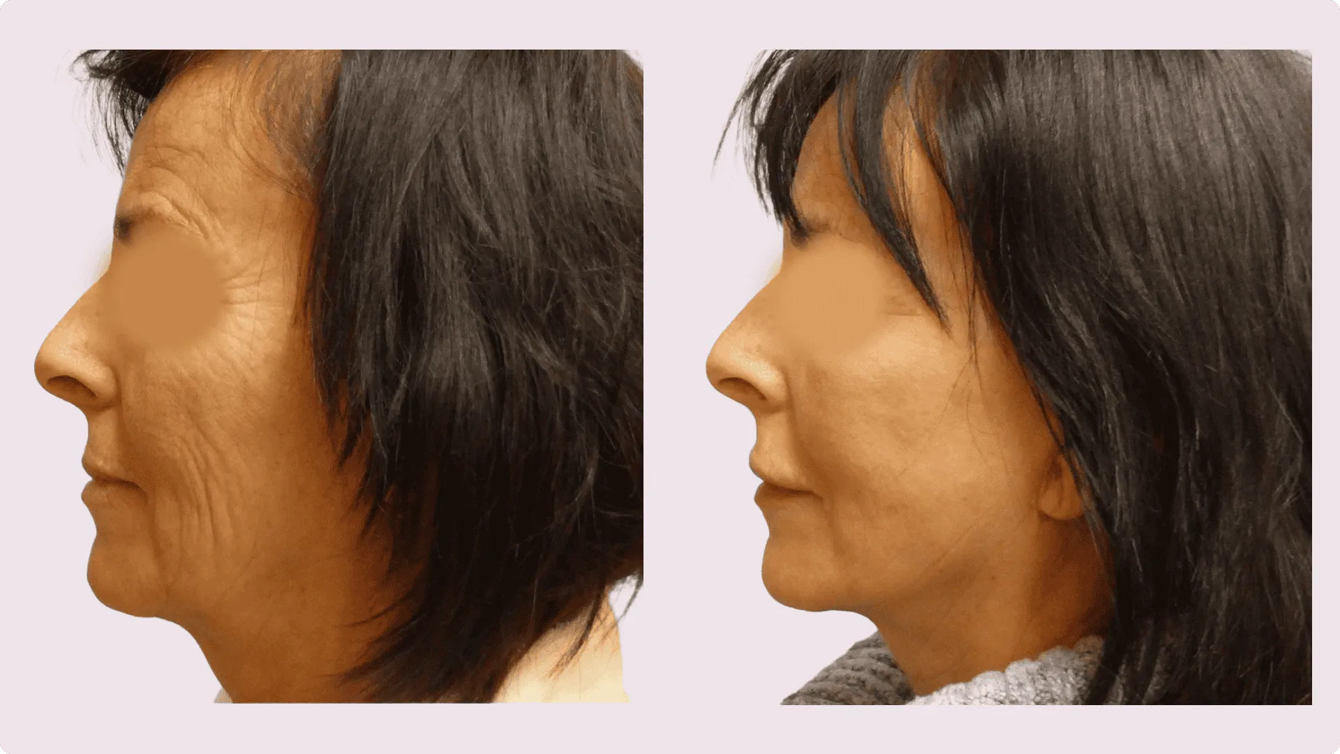 Facelift – Rhytidectomy – before and after photo 5