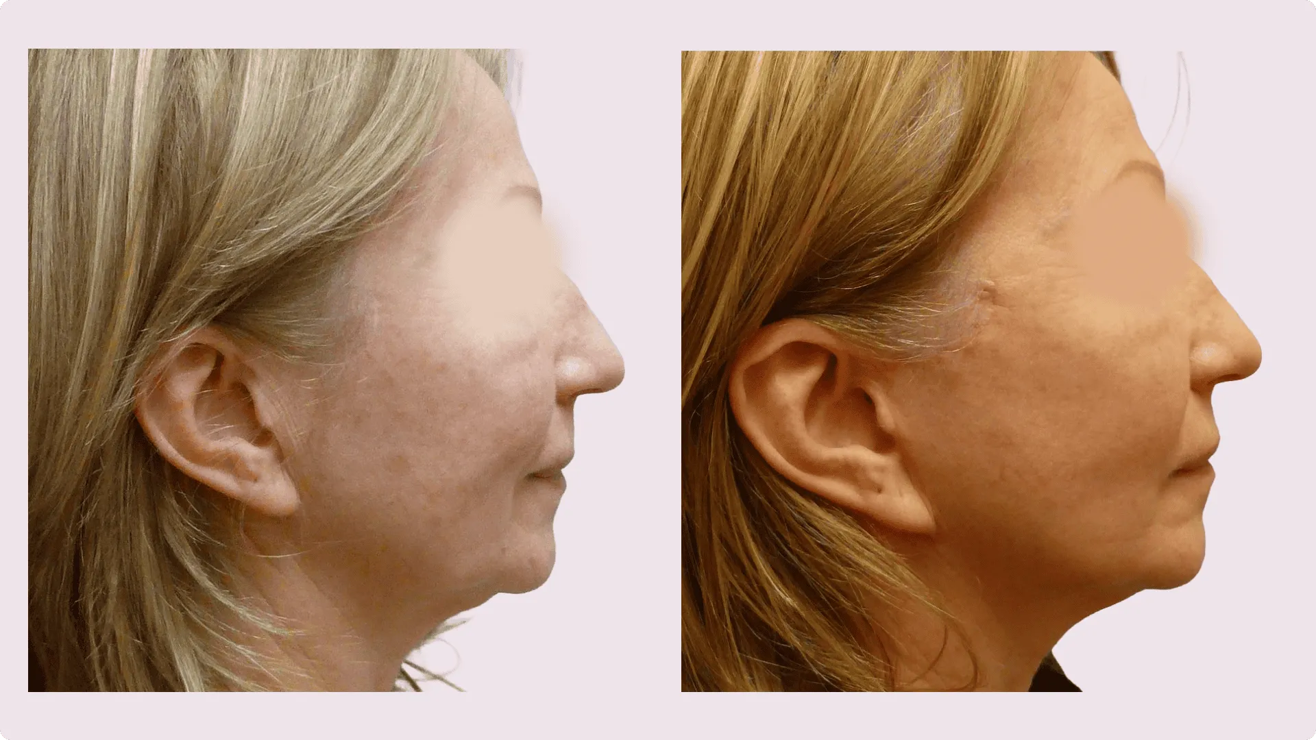 Facelift – Rhytidectomy – before and after photo 7