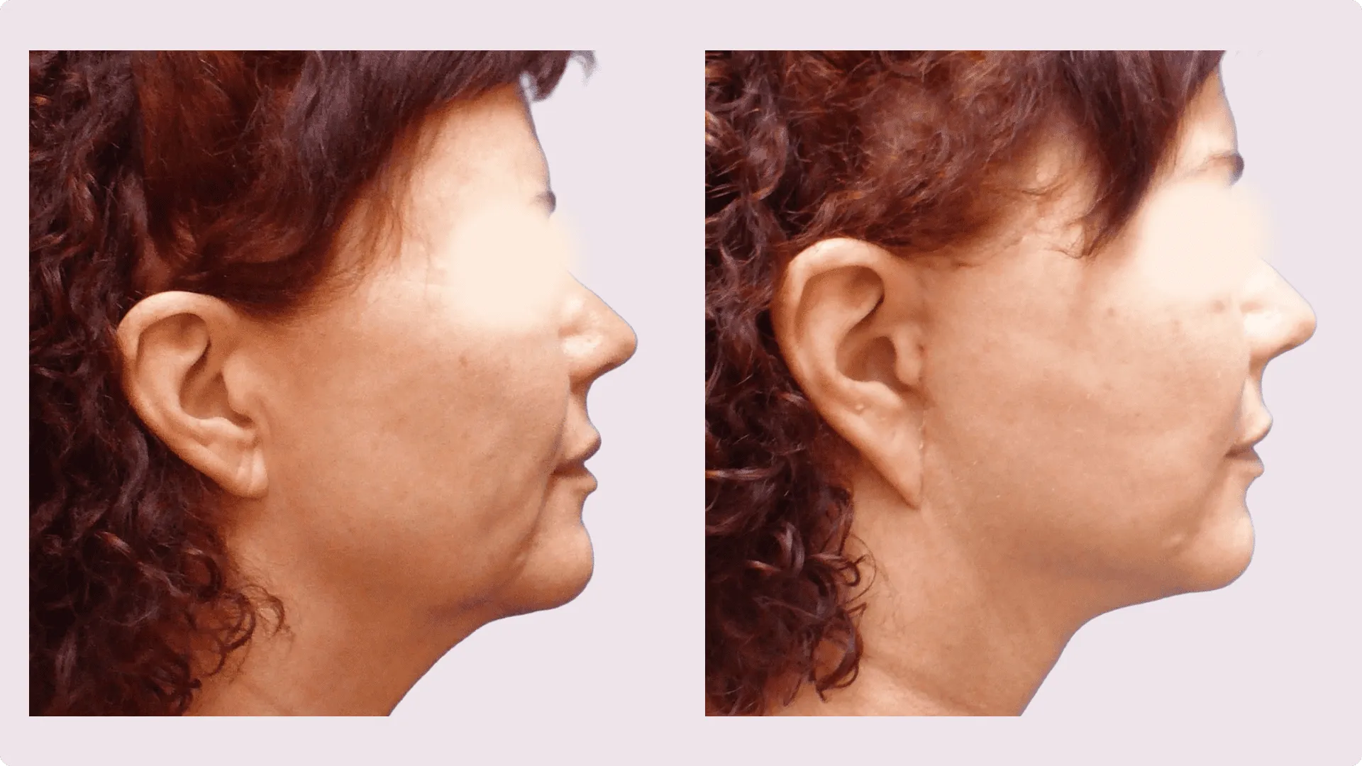 Facelift – Rhytidectomy – before and after photo 9
