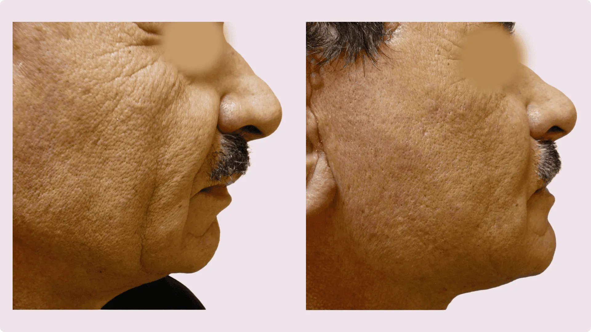 Facelift – Rhytidectomy – before and after photo 10