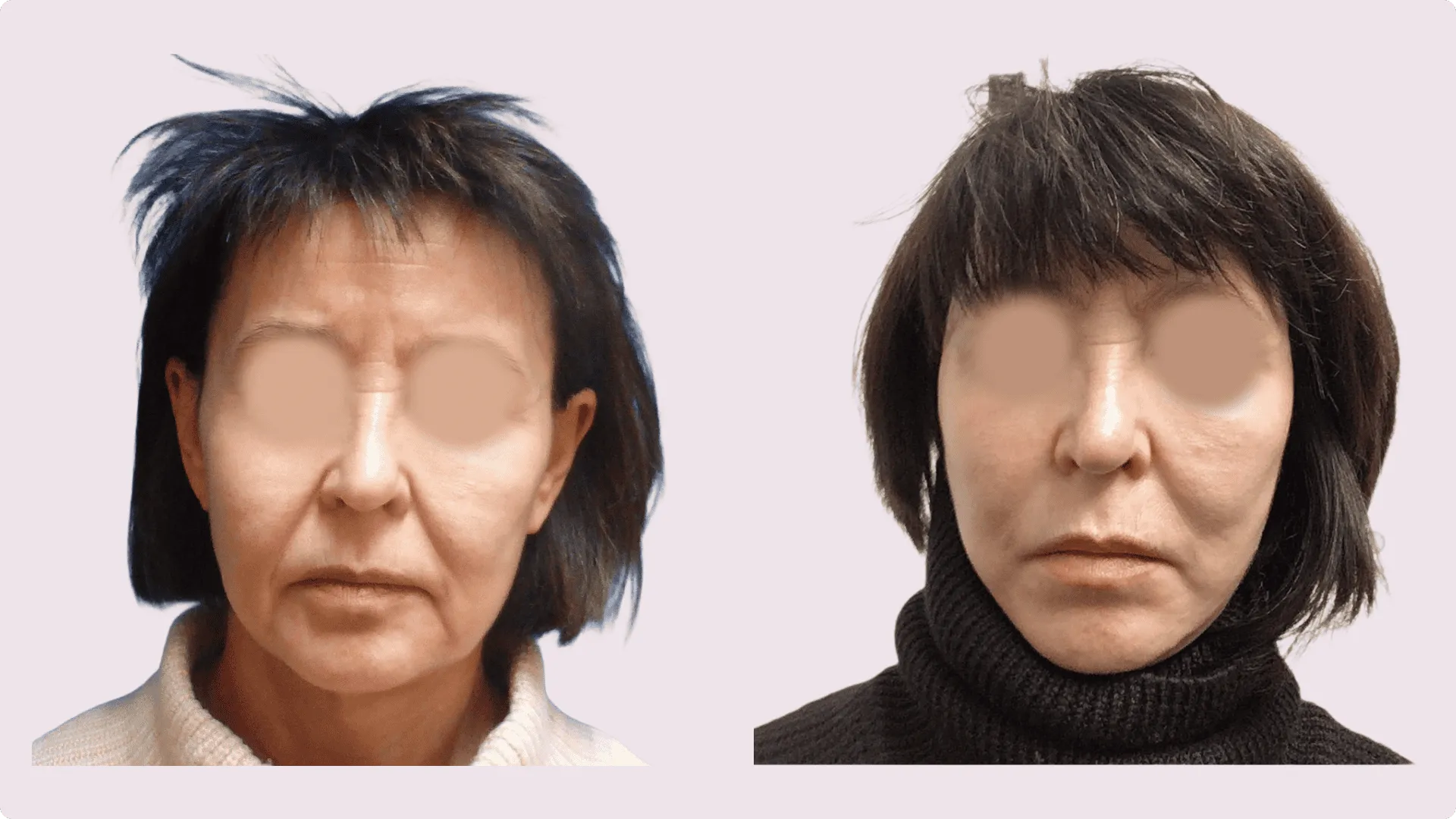 Facelift – Rhytidectomy – before and after photo 11