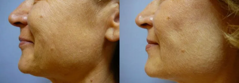 Ліфтинг обличчя (Ритидектомія) – результат 1