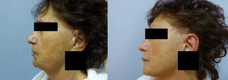 Ліфтинг обличчя (Ритидектомія) – результат 2