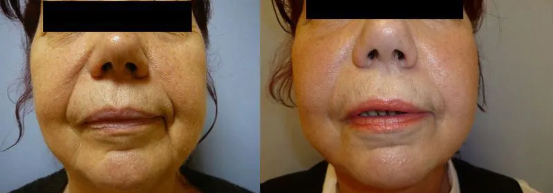 Ліфтинг обличчя (Ритидектомія) – результат 3
