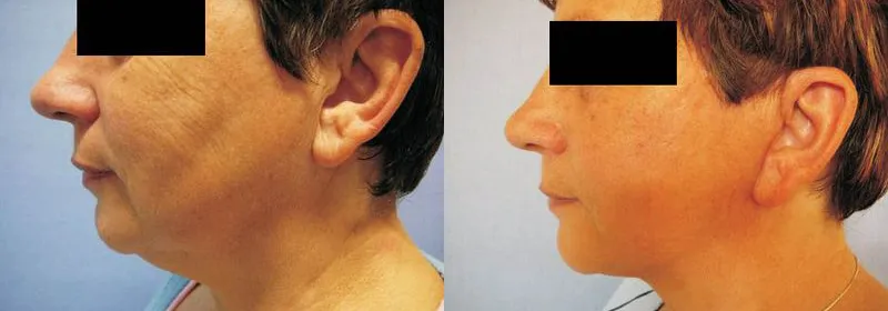 Ліфтинг обличчя (Ритидектомія) – результат 4