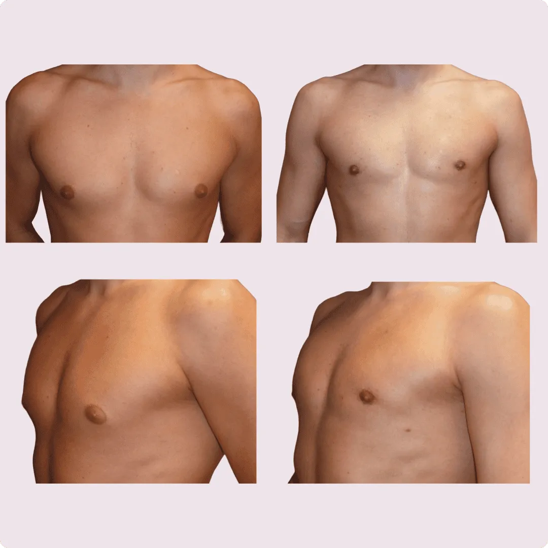 Gynecomastia – before and after photo 1