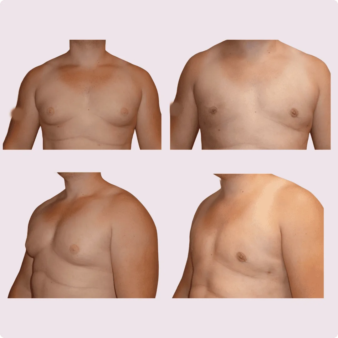 Gynecomastia – before and after photo 2