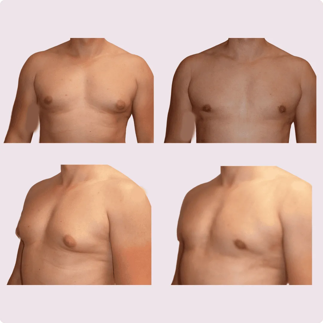 Gynecomastia – before and after photo 3
