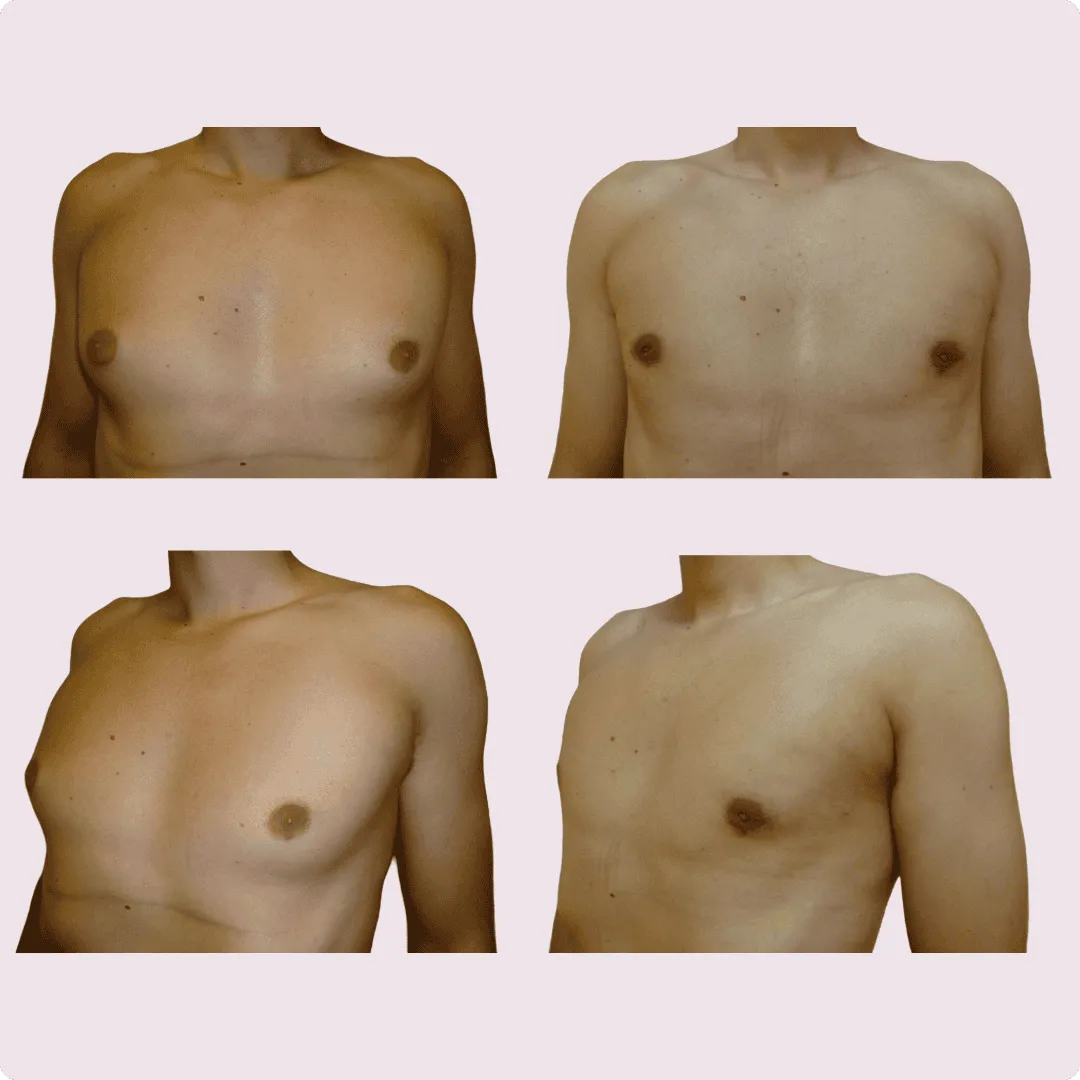 Gynecomastia – before and after photo 4