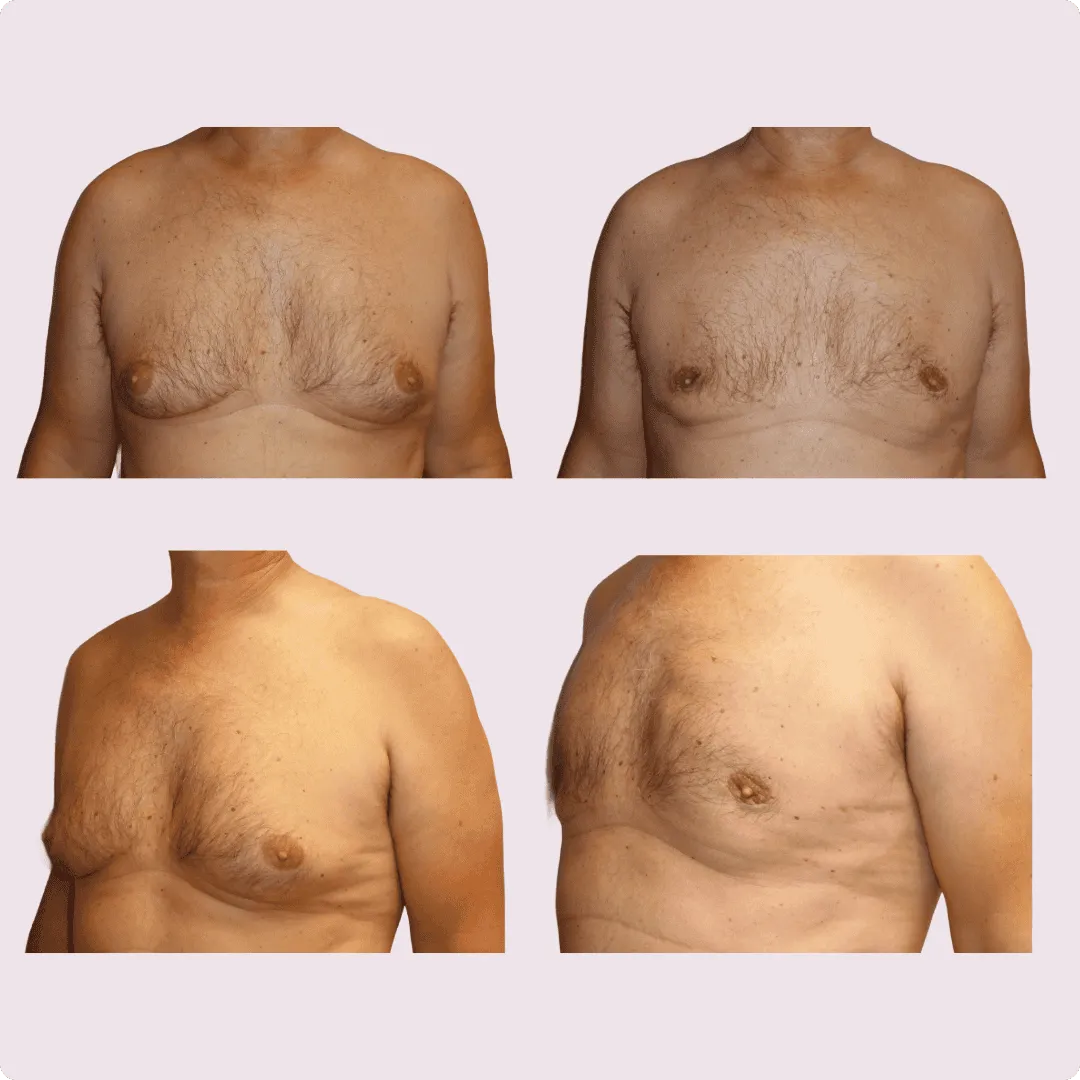 Gynecomastia – before and after photo 5