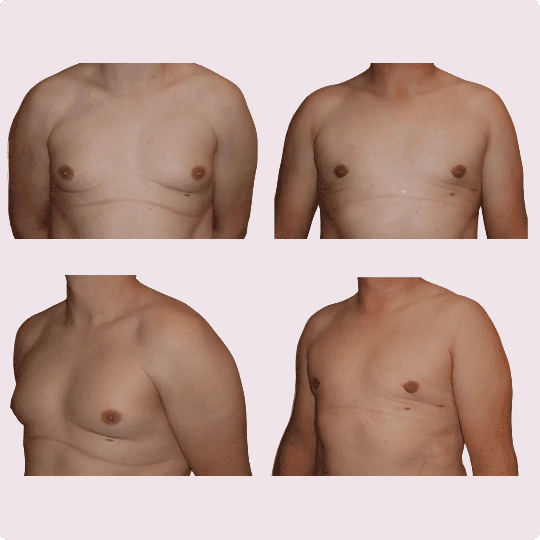 Gynecomastia – before and after photo 5