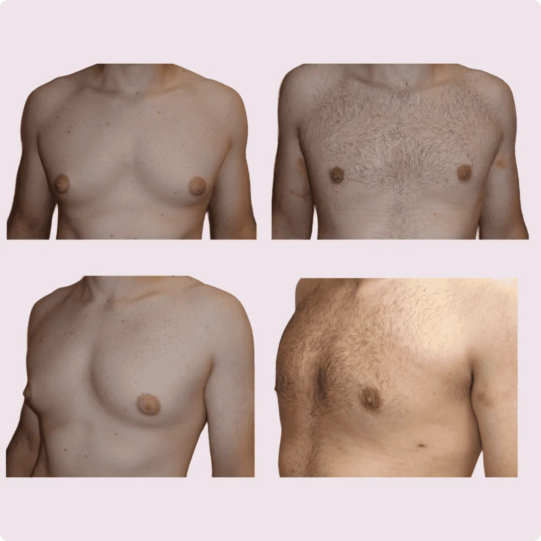 Gynecomastia – before and after photo 7