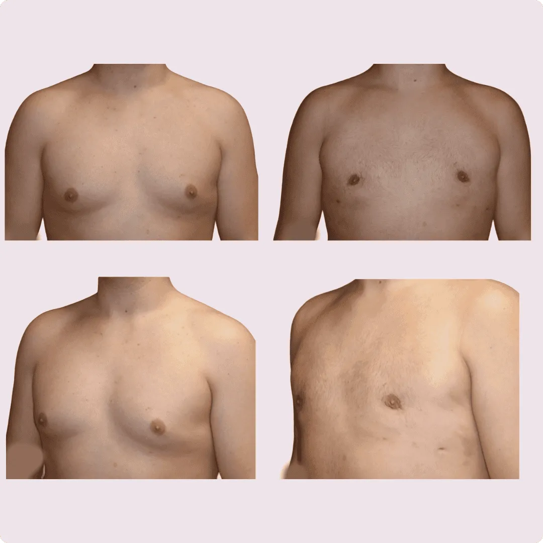 Gynecomastia – before and after photo 6