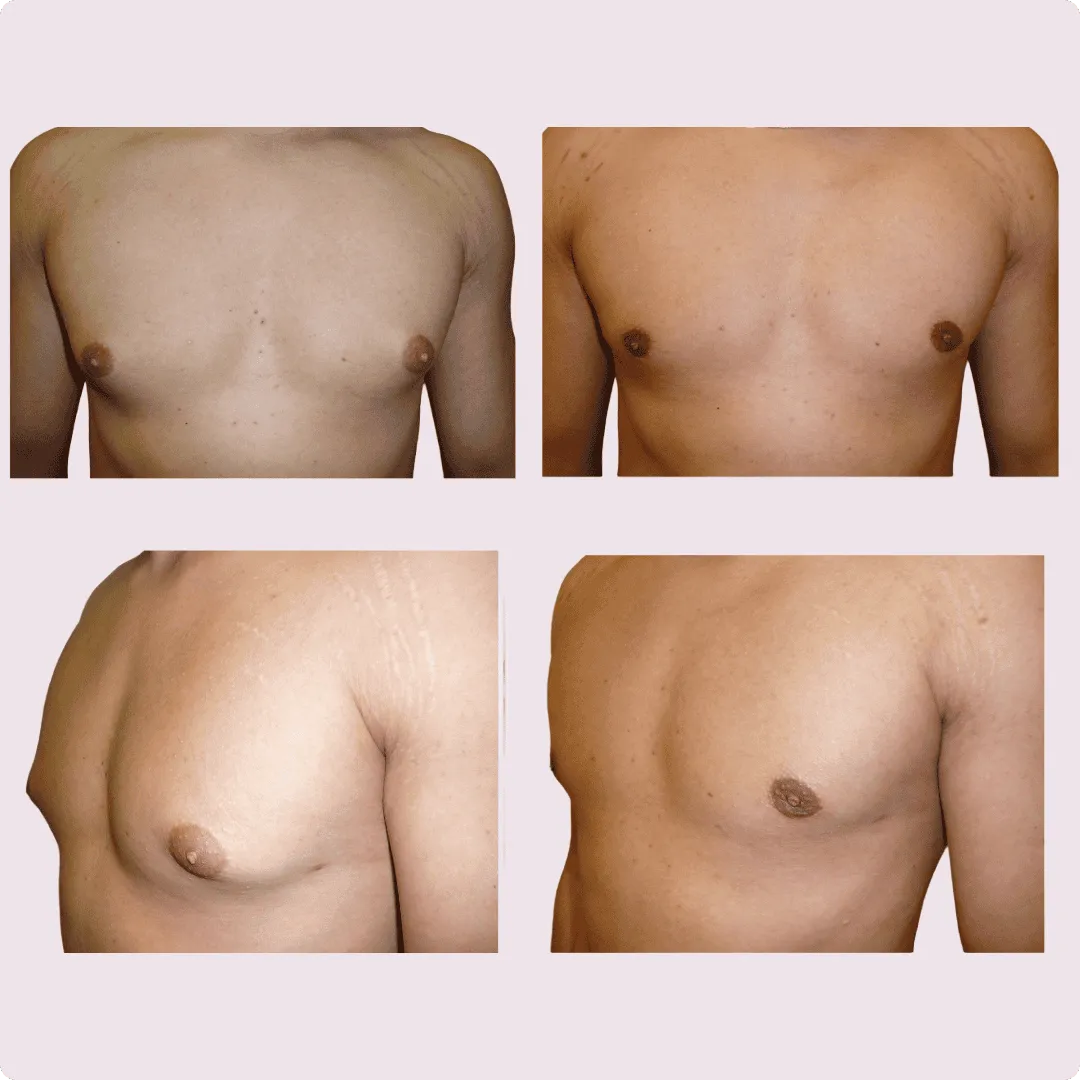 Gynecomastia – before and after photo 9