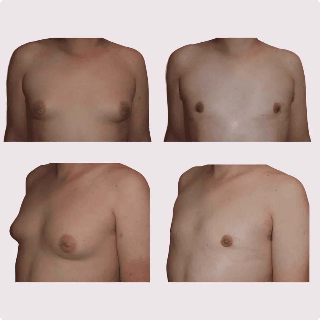 Gynecomastia – before and after photo 10