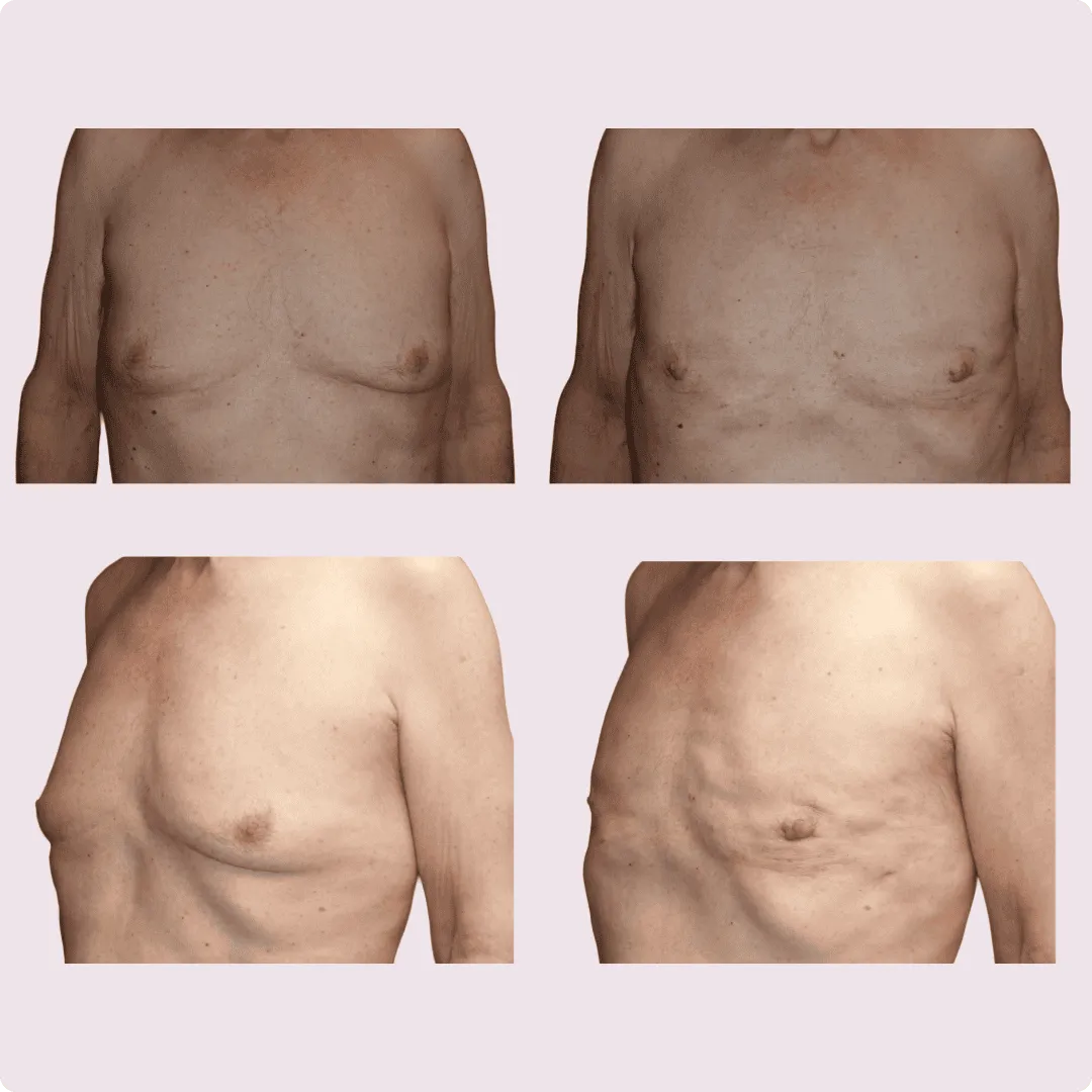 Gynecomastia – before and after photo 11