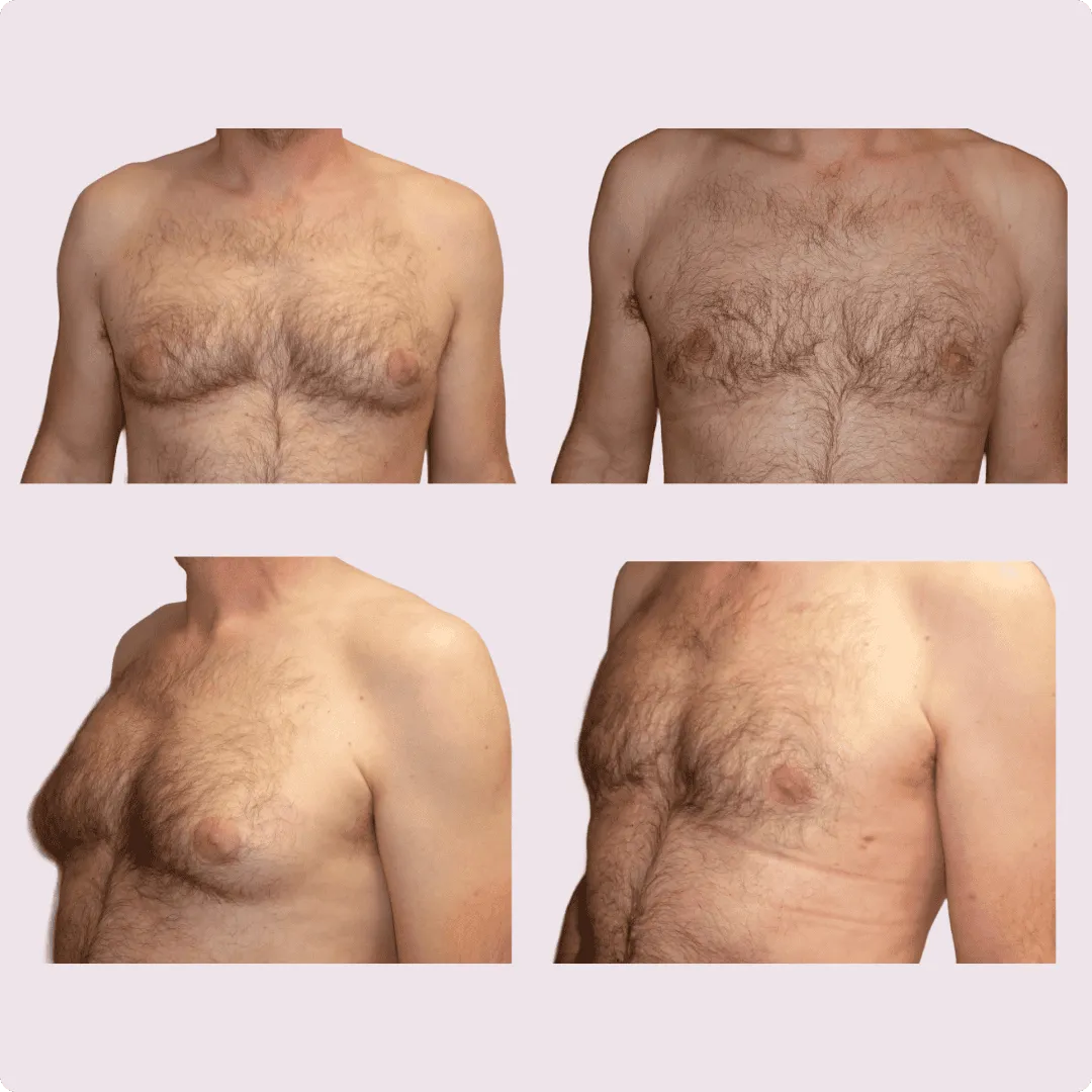 Gynecomastia – before and after photo 12