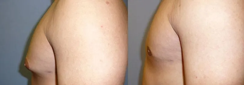 Гінекомастія (збільшення грудної залози) – результат 1