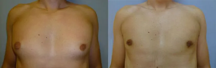 Гінекомастія (збільшення грудної залози) – результат 2