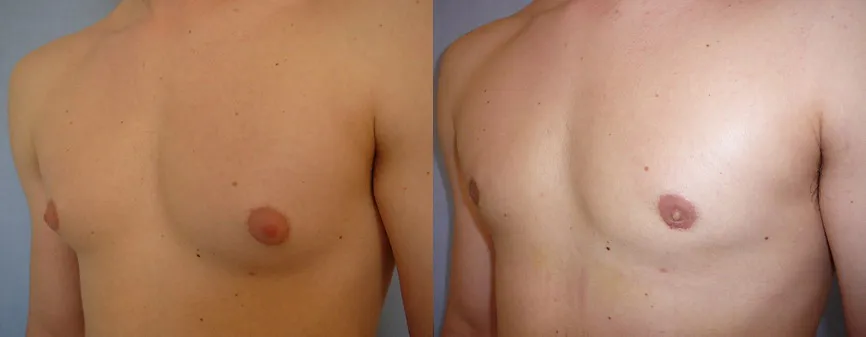 Гінекомастія (збільшення грудної залози) – результат 3