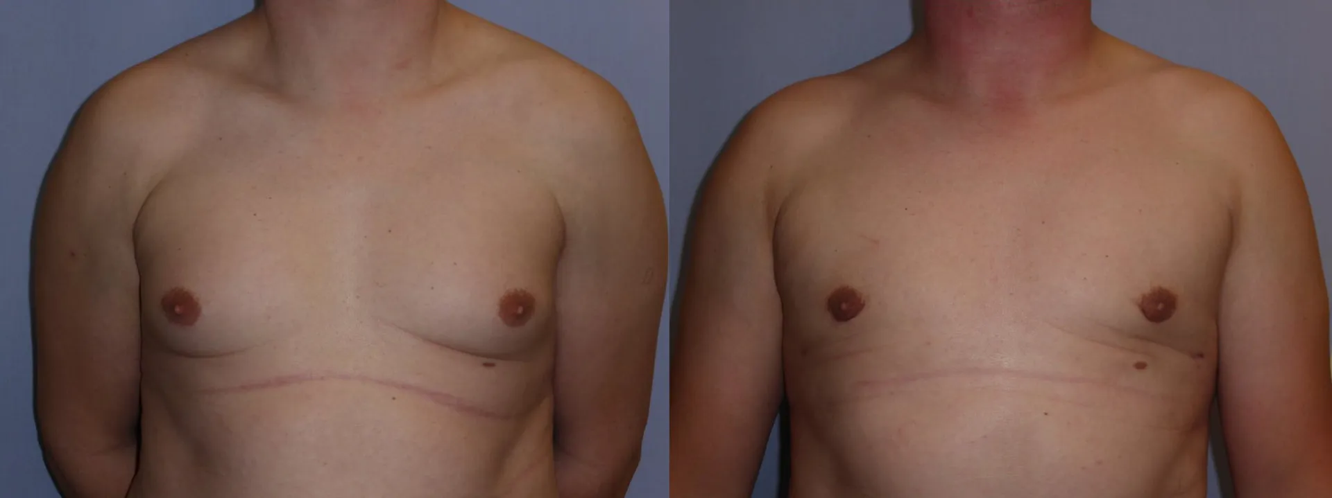 Гінекомастія (збільшення грудної залози) – результат 4