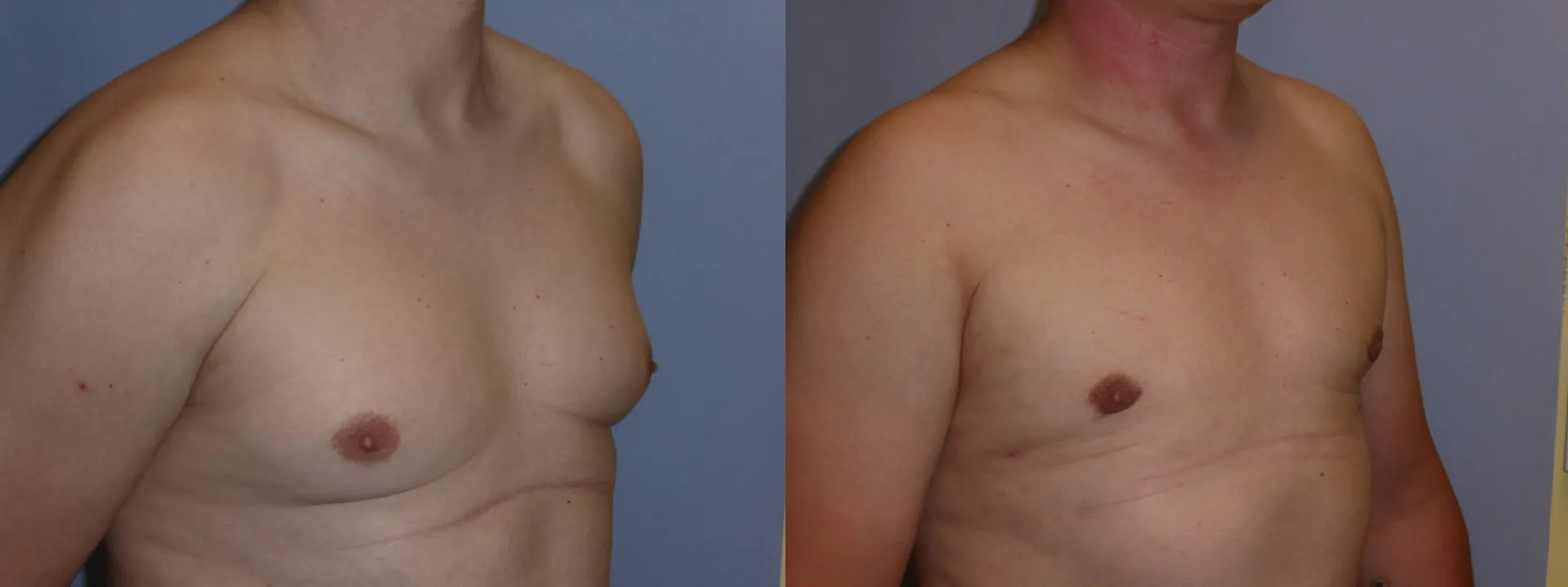 Гінекомастія (збільшення грудної залози) – результат 5
